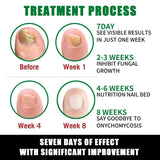 Ginger Nail Treatment Nail Support Nail Care